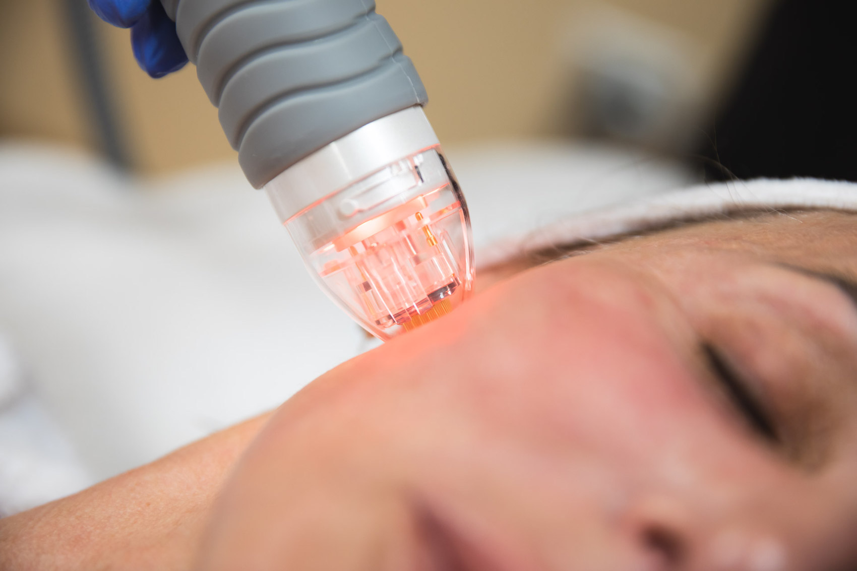 Stretch mark reduction treatment